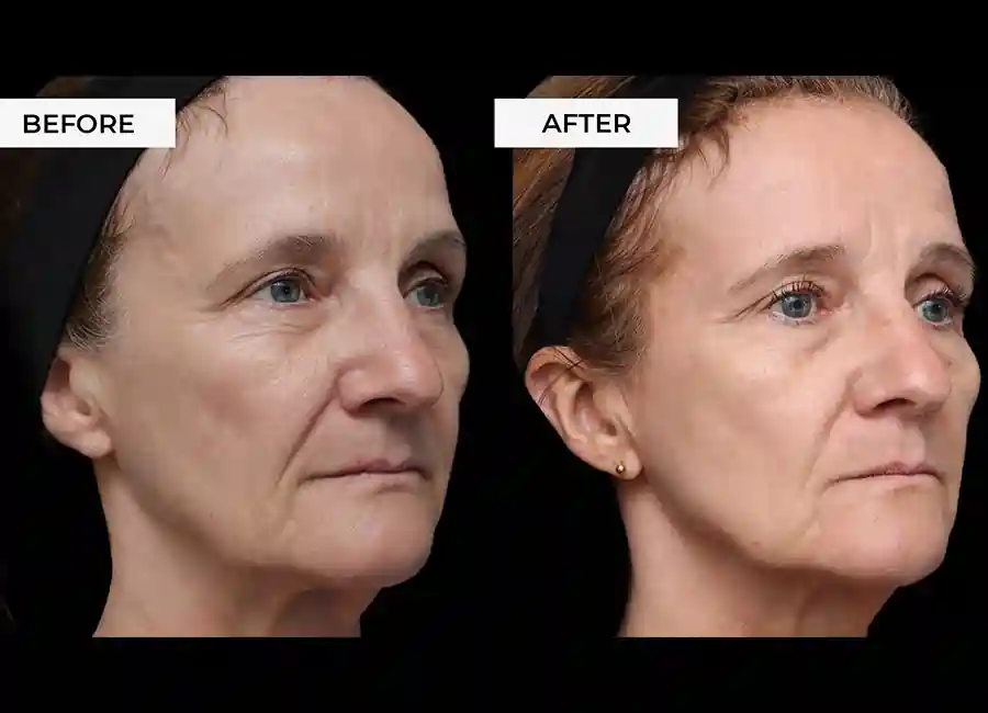 How Many RF Microneedling Sessions Will You Need to See a Difference Grimsby?