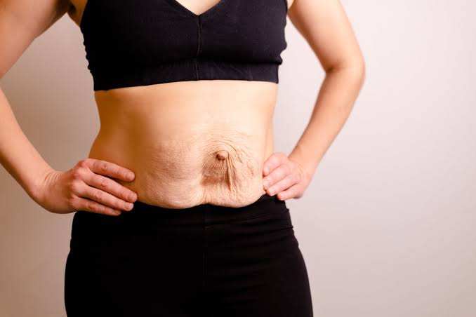 Is Surgery Really the Only Way to Repair Diastasis Recti Grimsby?