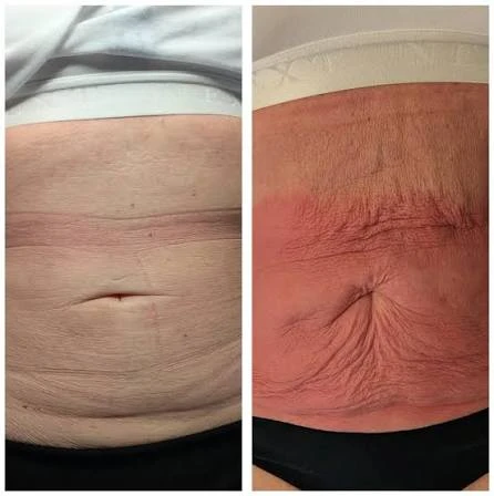 How Does RF Microneedling Improve Crepey, Thin and Uneven Skin Texture Grimsby?