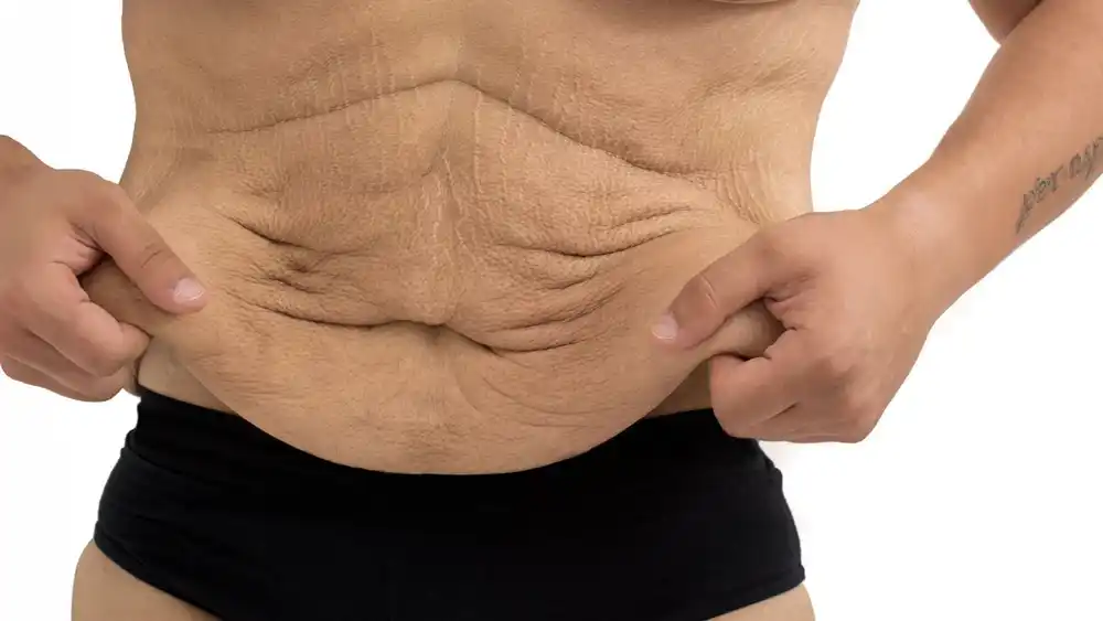 RF Microneedling for Loose Skin: How Can It Help Tighten and Reshape the Skin Grimsby?